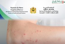 صورة وزارة الصحة والحماية الاجتماعية تعلن عن ارتفاع حالات الحصبة بالمغرب